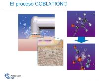 Procés Coblation Clínica de Girona